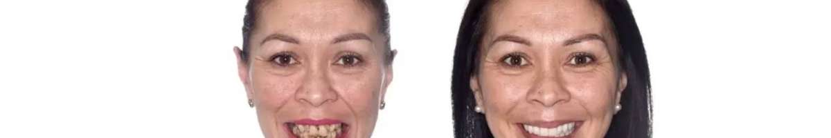 Dental Implants Brisbane | My Implant Dentist Banner