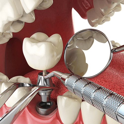Dental Implants Sunshine Coast
