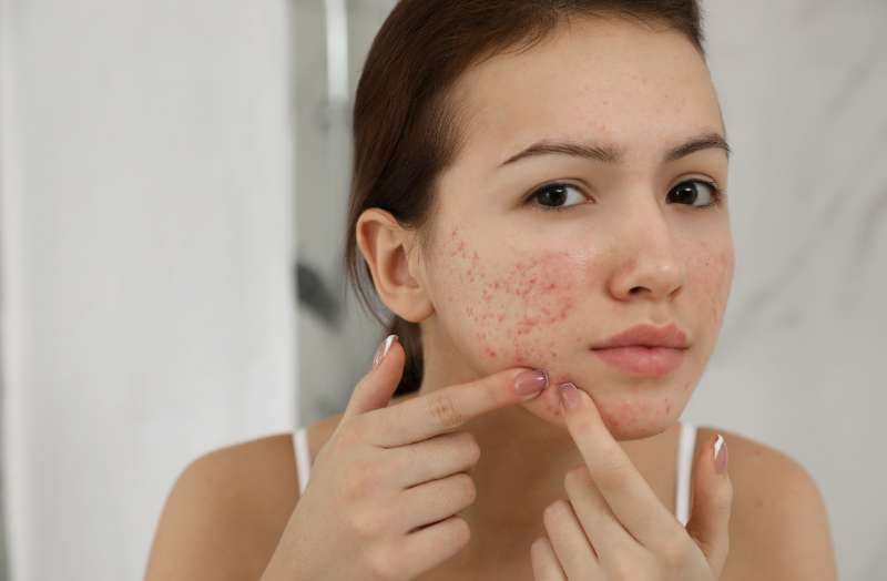 Best Acne Treatment That Works: Why Clinical Facials Clear the Breakout Cycle