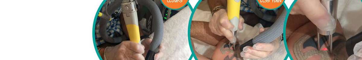 Renude Laser Tattoo Removal Banner