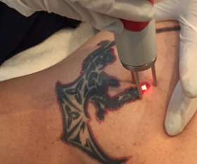 Renude Laser Tattoo Removal