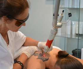 Renude Laser Tattoo Removal