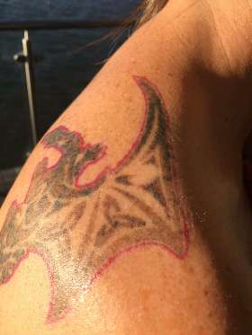 Renude Laser Tattoo Removal