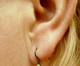 Cosmetic Medical Centre Ear Pinning Surgery