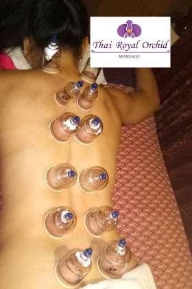 Cupping Therapy in Nundah