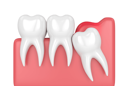 Wisdom Teeth Removal