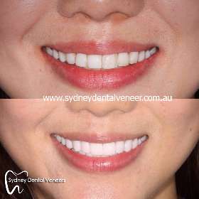 Sydney Dental Veneers