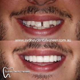 Sydney Dental Veneers