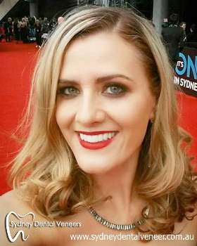 Sydney Dental Veneers