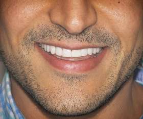 Sydney Dental Crowns