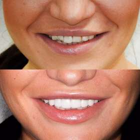 Sydney Dental Crowns