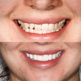 Sydney Dental Crowns