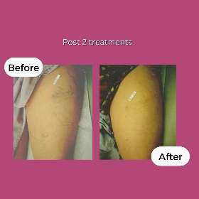 Post 2 treatments - Spider Veins - Rejuvenate Wellness Centre
