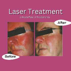1 Week post 3 treatments - Rejuvenate Wellness Centre