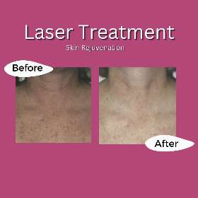 Skin rejuvenation - Rejuvenate Wellness Centre