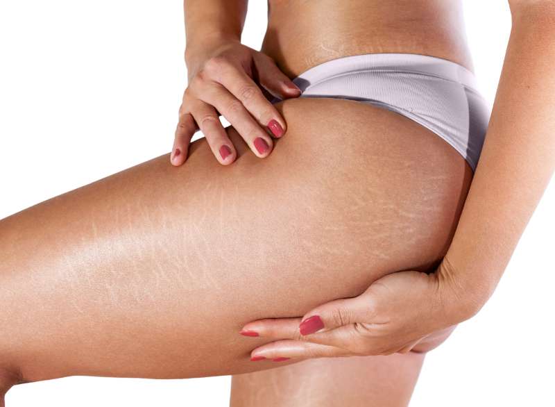 Smooth away Scars and Stretch Marks: Reclaim Your Confidence