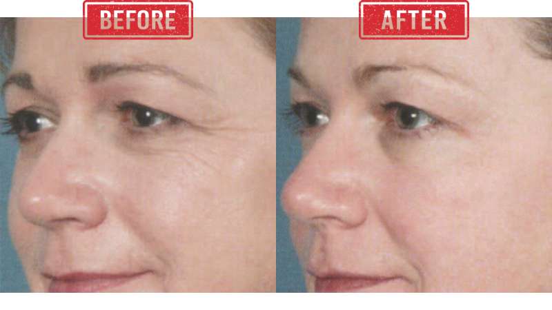 Elos ReFirme Skin Tightening