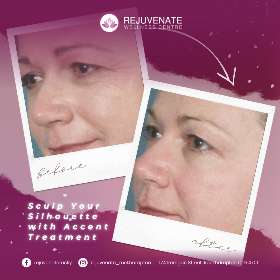 Target stubborn fat and tighten your skin with Accent Treatment! 