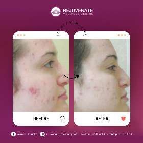 Laser Trearments - Acne Treatment