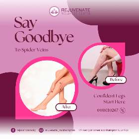 Concerns - Spider Veins