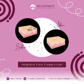 Concerns - Pigmentation