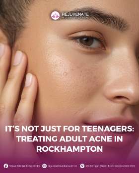 It’s Not Just for Teenagers: Treating Adult Acne in Rockhampton