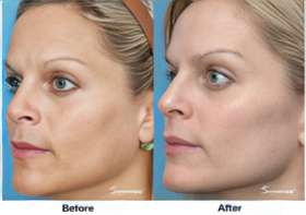 Elos Technology Skin Rejuvenation Treatments at Rejuvenate Wellness Centre