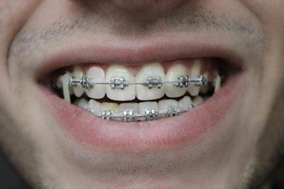 Discover the Best Teen Orthodontist in North Strathfield