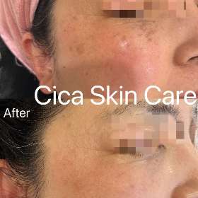 Laser Skin Treatment - Cica Skin Care
