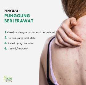 Back Acne bikin gapercaya diri? Cek penyebabnya | Evita Skin Care