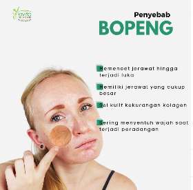 Penyebab bopeng | Ecvita Skin Care