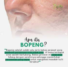 Apa itu bopeng? | Evita Skin Care