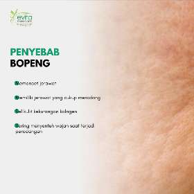 Penyebab Bopeng | Evita Skin Care