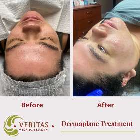 Dermaplaning treatment before and after | Veritas Medical Center