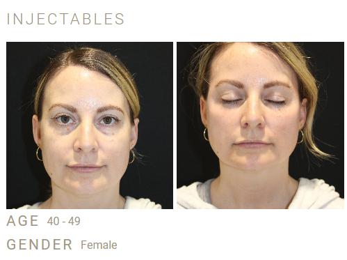 Unlock the Benefits of Neuromodulator Membership: BOTOX®, XEOMIN®, and Dysport®