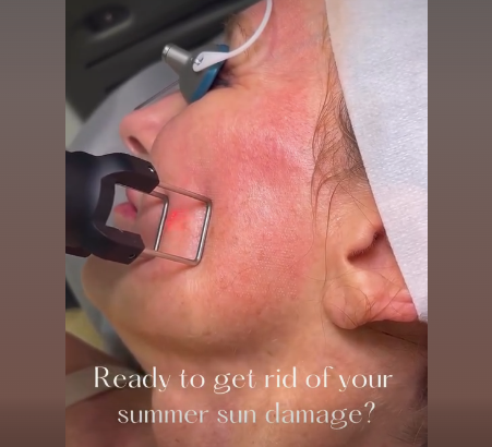 Rejuvenate Your Skin with CoolPeel Tetra Laser: The Ultimate Solution for Summer Damage