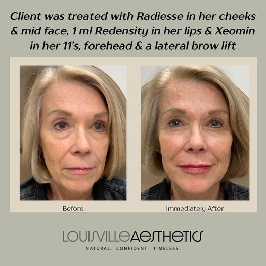 Discover Your Radiance at Louisville Aesthetics MedSpa