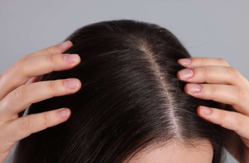 How to Get Rid of Dry Scalp & Flakes in Autumn and Why Your Shampoo Keeps Failing You