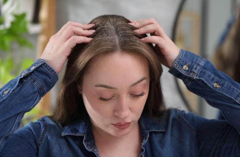 Wet Dandruff: What It Actually Is, Why It Keeps Coming Back