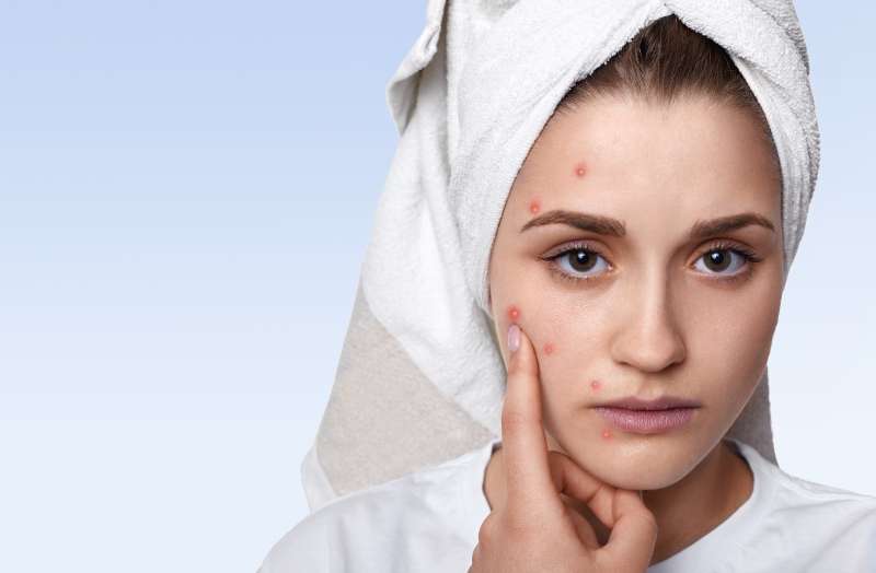 How to Treat Hormonal Acne in Denver with Professional Facial Treatments