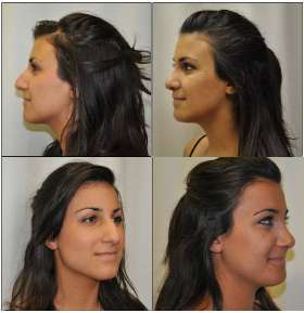 Rhinoplasty done by Dr. Barnouti