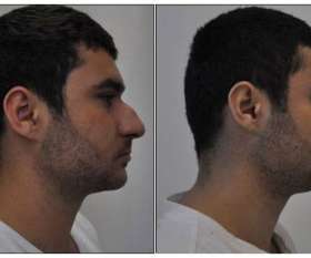 Australia Plastic Surgery