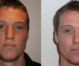 Rhinoplasty done by Dr. Kohout. Front on view.