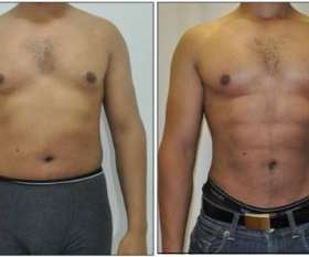 Abdominal etching done by Dr. Barnouti