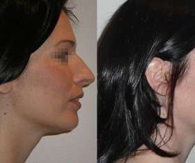 Rhinoplasty done by Dr. Kohout. Side on view.