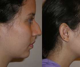 Australia Plastic Surgery