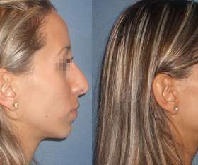 Rhinoplasty done by Dr. Kohout. Side on view.