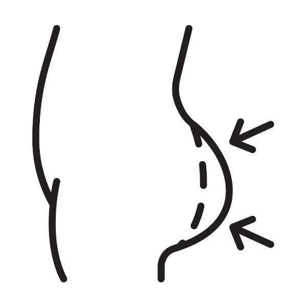 Buttocks Liposuction