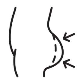 Buttocks Liposuction