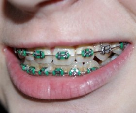 Why You Shouldn’t Wear DIY Braces